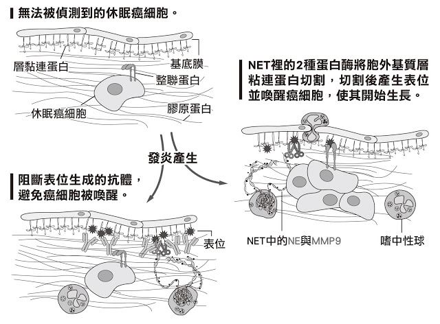 預防癌症轉移與復發有譜 阻絕網狀結構成關鍵 