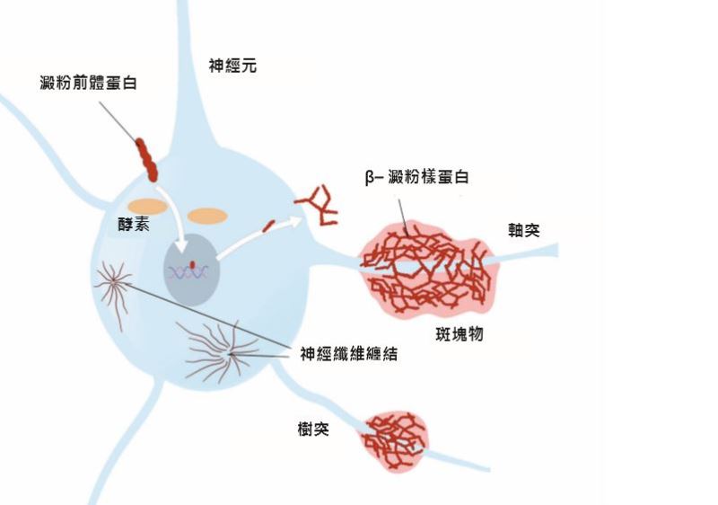 人類的長期抗戰─對抗阿茲海默症 