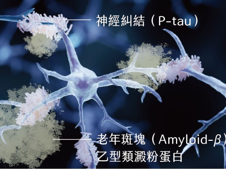 阿茲海默症不再無藥可治？新藥Lecanemab的機制與展望