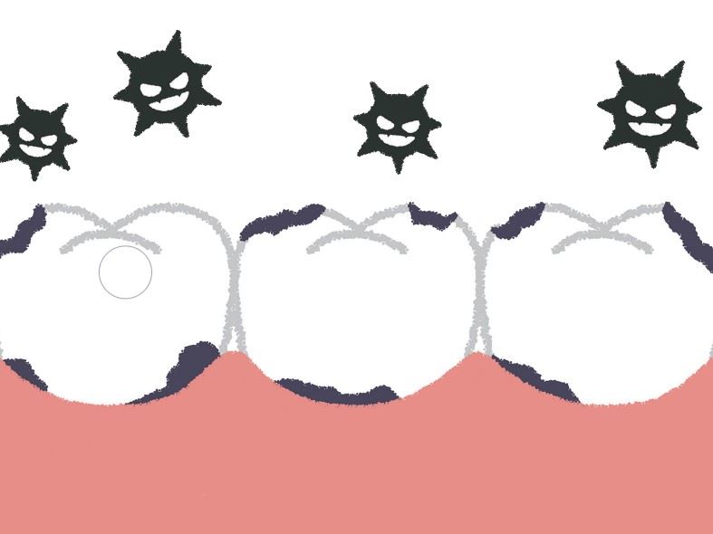 蛀牙為什麼要補？解密補牙過程中的科學