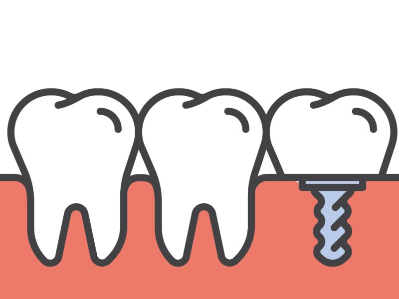 牙齒該如何重建修復？從人工植牙看牙科材料